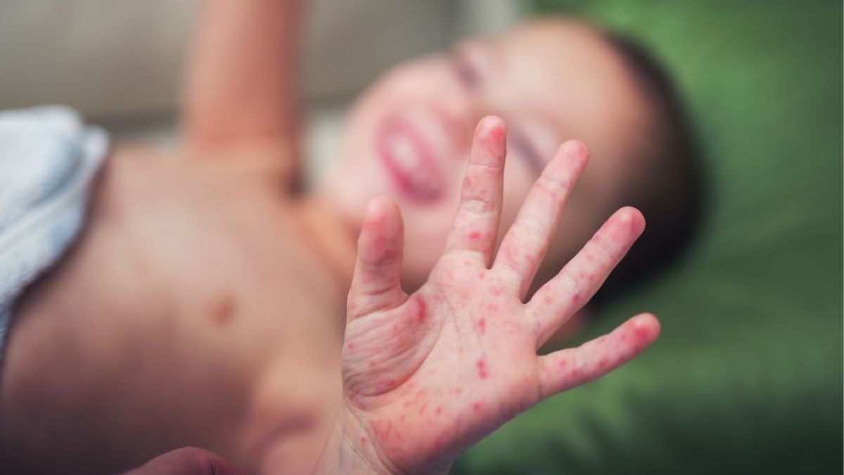 Anak Sudah Vaksin, tapi Kenapa Masih Kena Campak?