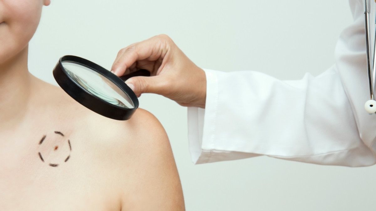 Perbedaan Kanker Kulit Melanoma dan Karsinoma