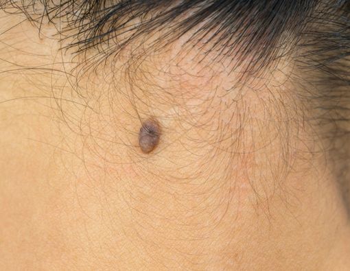 Ternyata Ini Fungsi Tahi Lalat di Tubuh