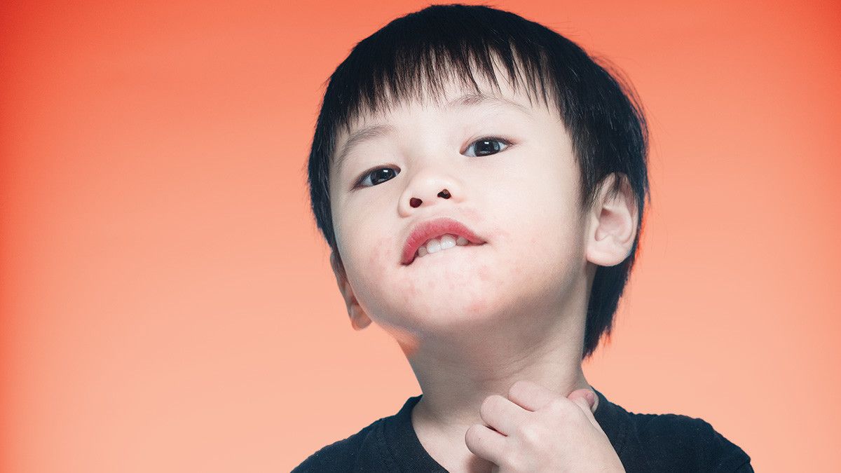 Tips Terapi Rumah Untuk Alergi Pada Anak