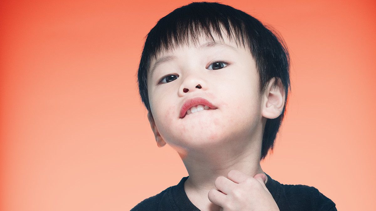 Ciri Si Kecil Alami Alergi Susu Sapi