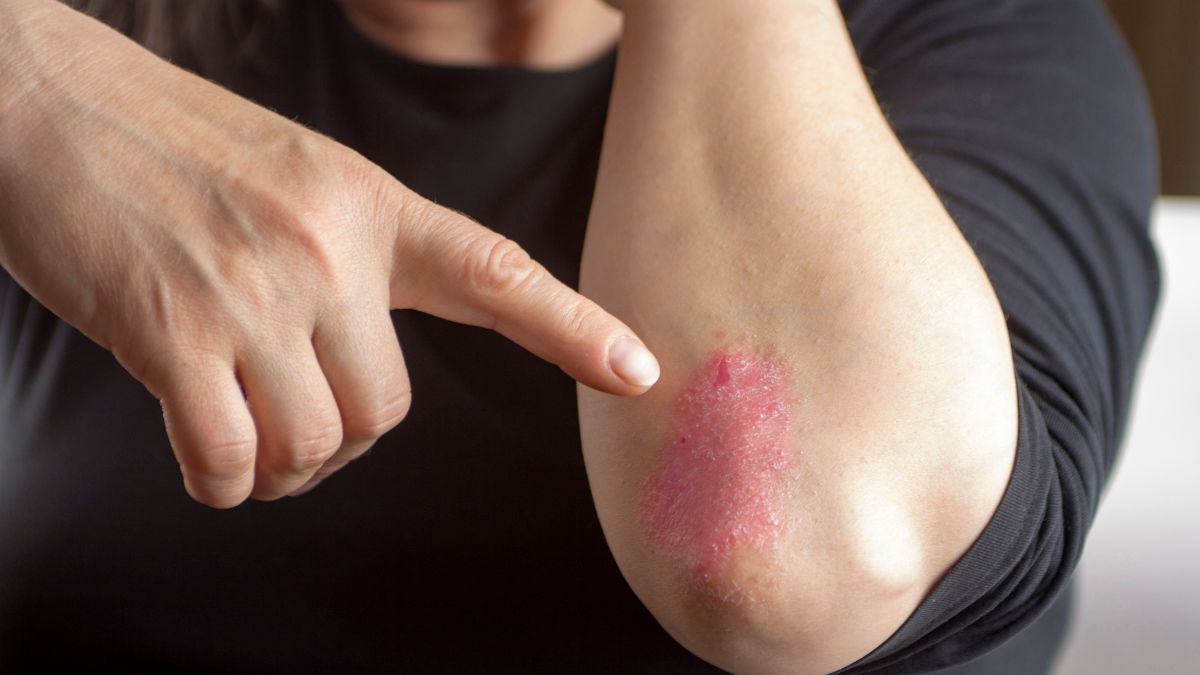 Kulit Bersisik Hingga Bernanah, Ini 7 Gejala Psoriasis yang Perlu Diwaspadai