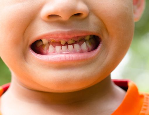 Kebiasaan Buruk Yang Bisa Merusak Gigi Anak