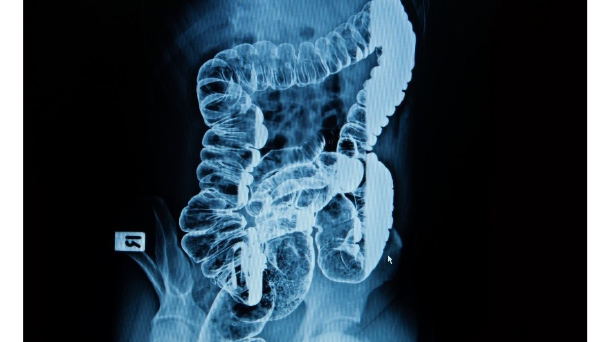 Persiapan dan Prosedur Barium Enema