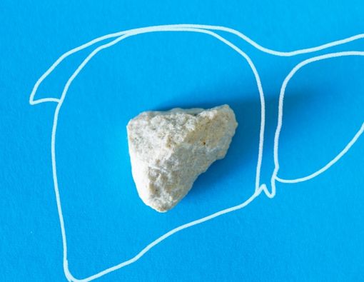 Mengenali Tanda-Tanda Batu Ginjal