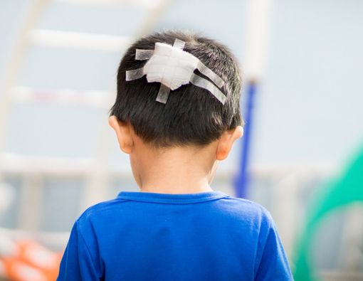 Pertolongan Pertama Saat Kepala Anak Bocor Akibat Cedera