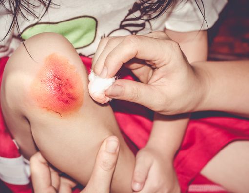 Tips Merawat Anak dengan Hemofilia