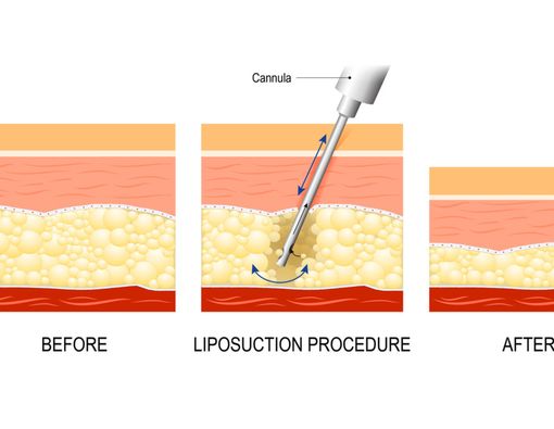 Sedot Lemak Saat Operasi Caesar, Bolehkah?