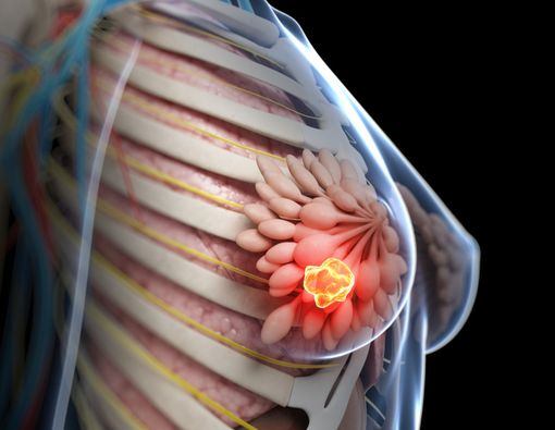 Kanker Payudara Bisa Menyerang Anak, Benarkah?