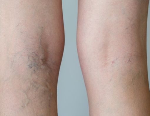 Chronic Venous Insufficiency