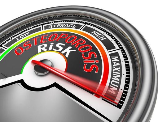 Osteoporosis, Penyakit Berbahaya yang Tidak Bergejala