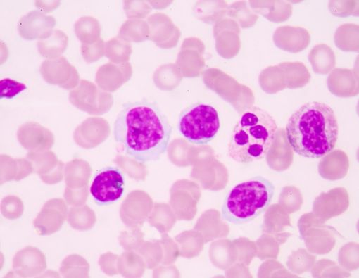 Kiat Hidup Sehat untuk pengidap Kanker Darah