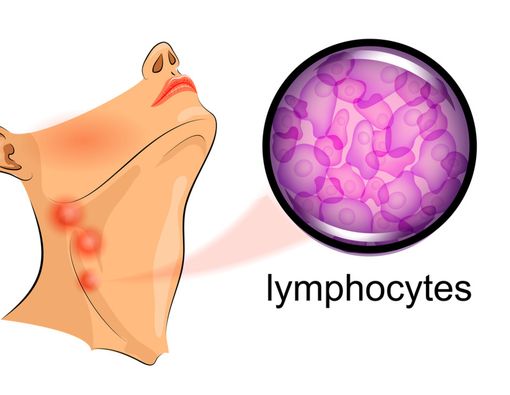 Waspada Limfoma, Ini yang Perlu Kamu Perhatikan