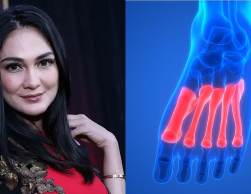 Ini Bahaya Cedera Tulang Metatarsal Seperti yang Dialami Luna Maya