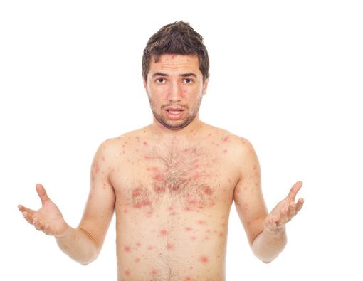 Langkah Tepat Mengobati Cacar Air pada Orang Dewasa