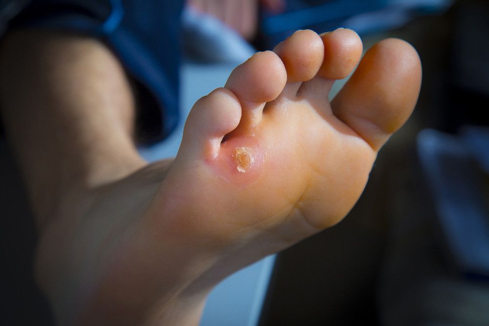 Lakukan Tips Ini agar Terhindar dari Mata Ikan