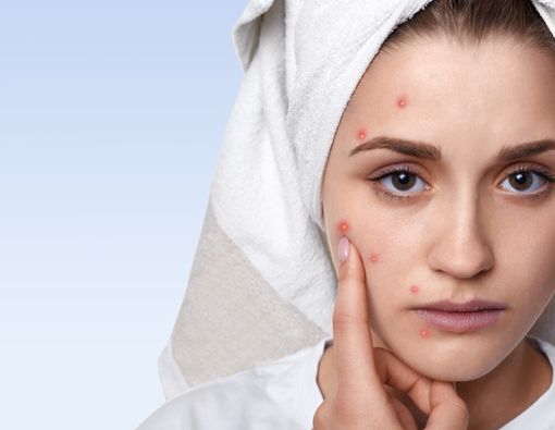 Berbagai Cara untuk Mengobati Jerawat Saat Hamil