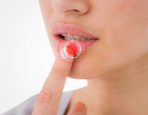 Tak Hanya Kurang Vitamin C, Ini 7 Alasan Anda Sering Sariawan