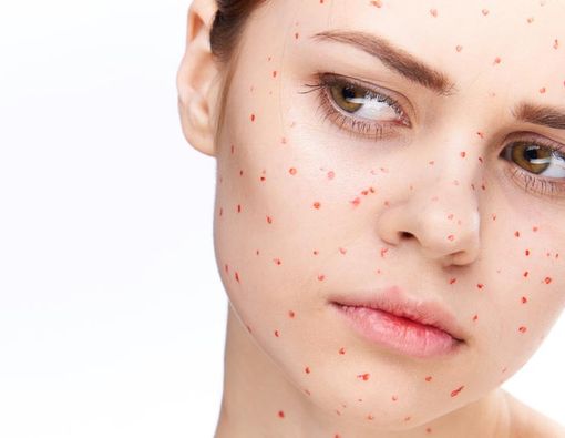 Mengenal Ragam Penyakit Cacar