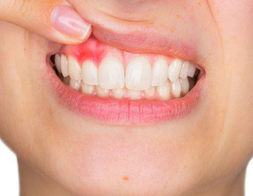 Penyakit Langka, Tumbuh Rambut di Gusi