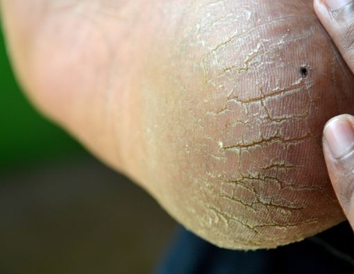 Mengobati Mata Ikan pada Telapak Kaki di Rumah