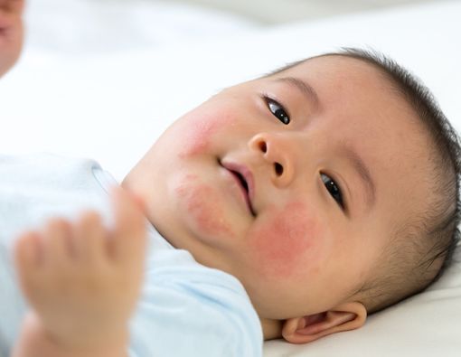 Alergi pada Kulit Bayi yang Perlu Anda Tahu
