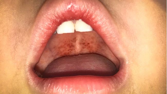 Pasien Difteri Bisa Sembuh, Asal Lakukan 5 Hal Ini