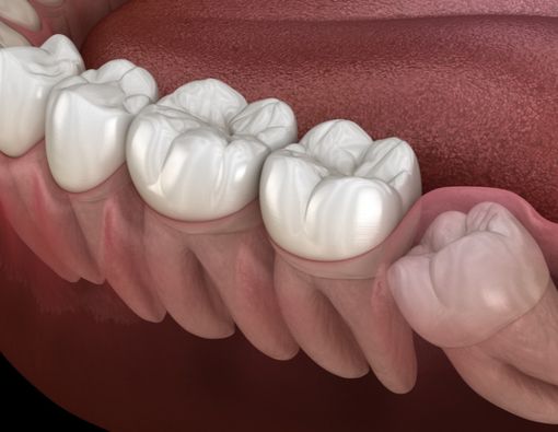 Kenali Gejala Impaksi Gigi, Kapan Harus ke Dokter?