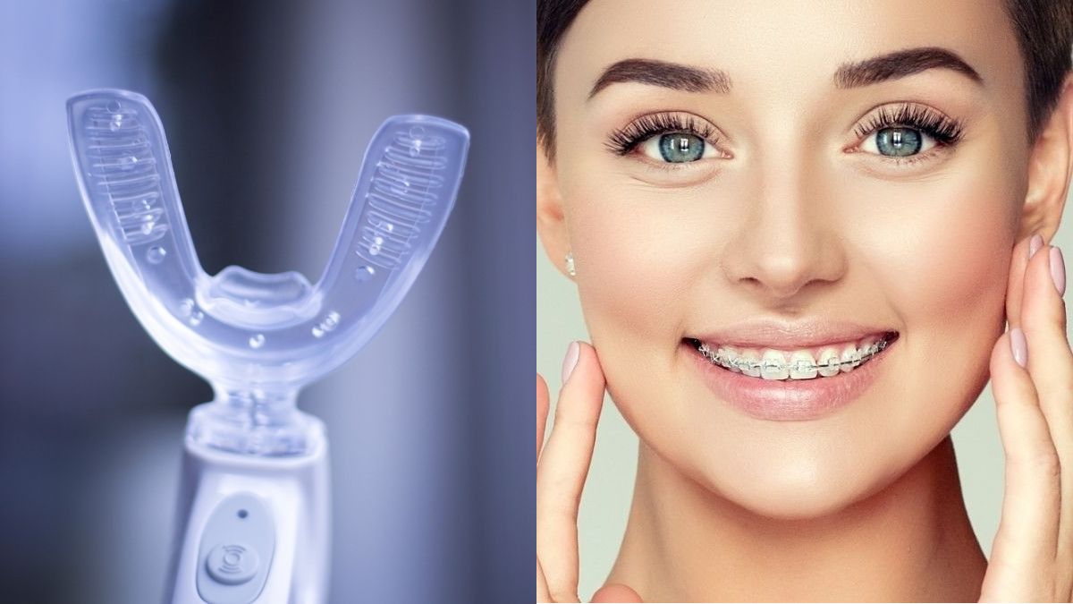 Kawat Gigi atau Aligners, Mana yang Lebih Higienis?