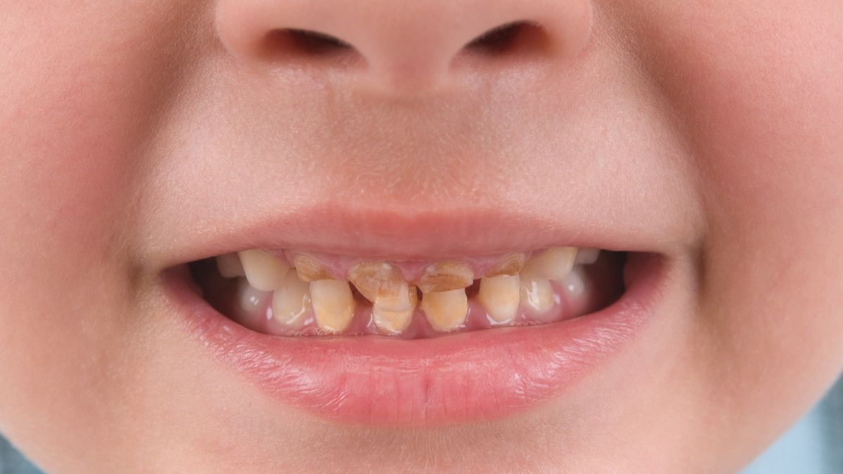 Penyebab Gigi Kuning pada Balita dan Cara Mengatasinya