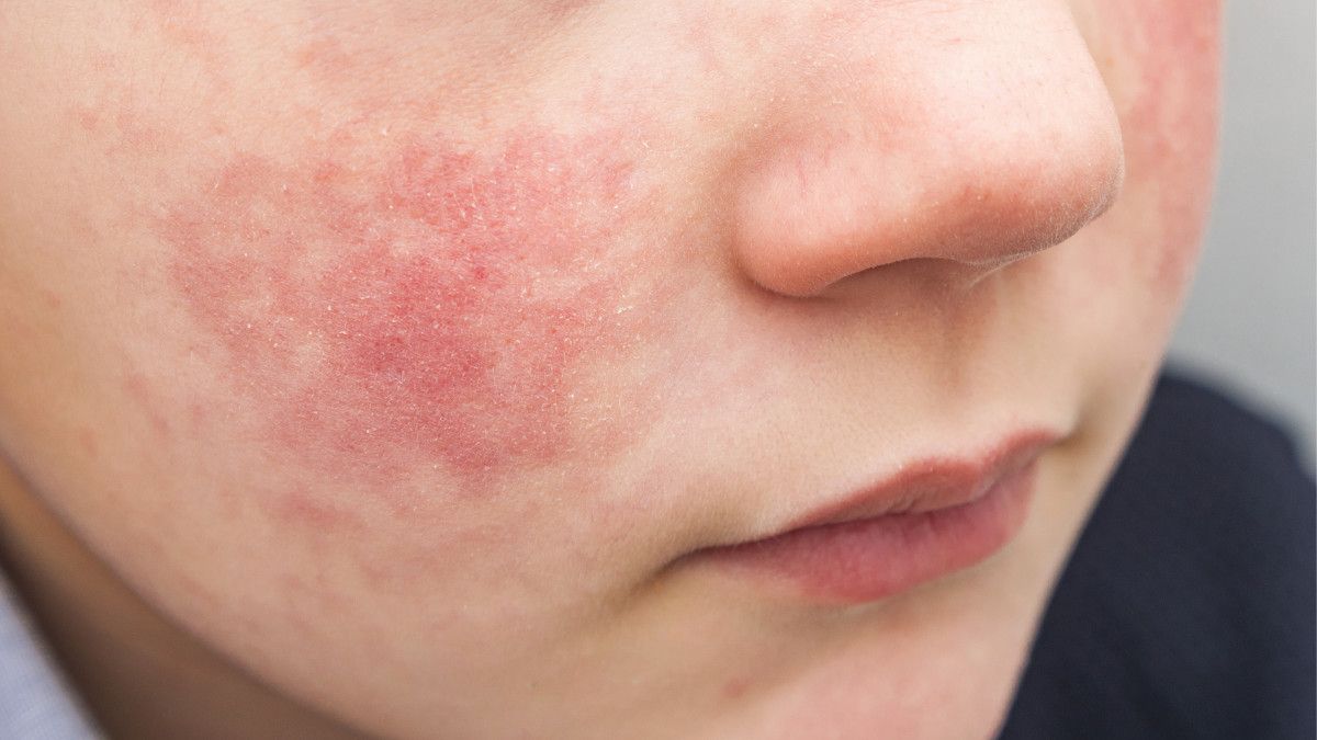 Cara Menghilangkan Eksim di Wajah yang Aman dan Efektif