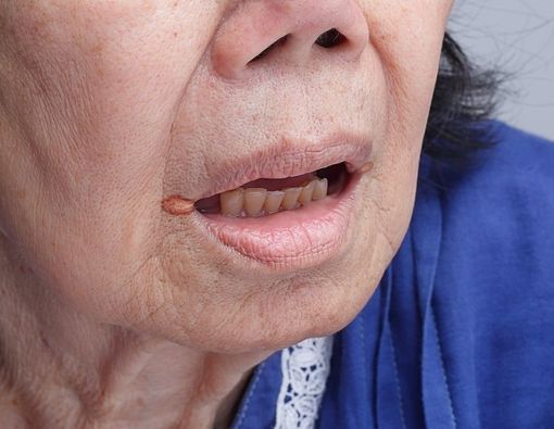 Lansia Berisiko Kena Angular Cheilitis, Kenapa?