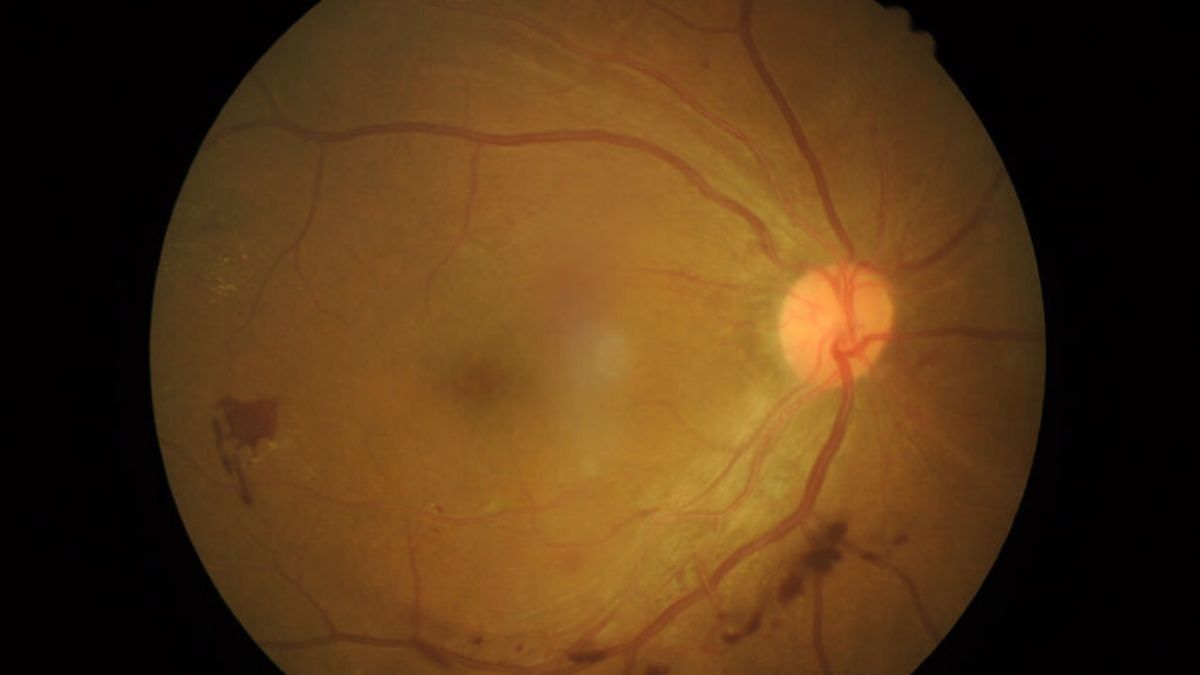 Tanda-Tanda Ablasi Retina Ini yang Sering Diabaikan, Mengapa?