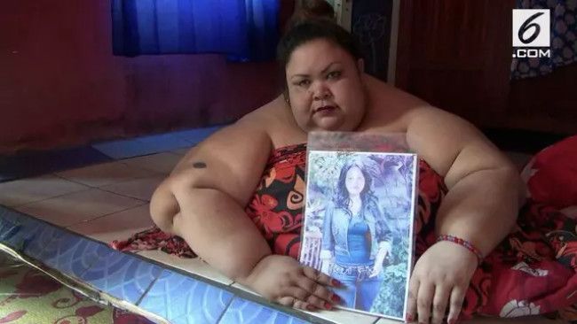 6 Penyakit Akibat Obesitas Rawan Dialami Wanita 350 kg di Kalteng