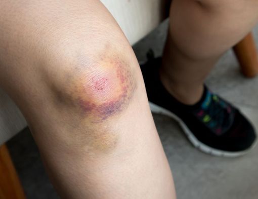 8 Penyebab Tubuh Gampang Memar, dari Kurang Vitamin Sampai Penyakit Serius