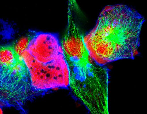 Daftar Pengobatan Penyakit Neuroblastoma