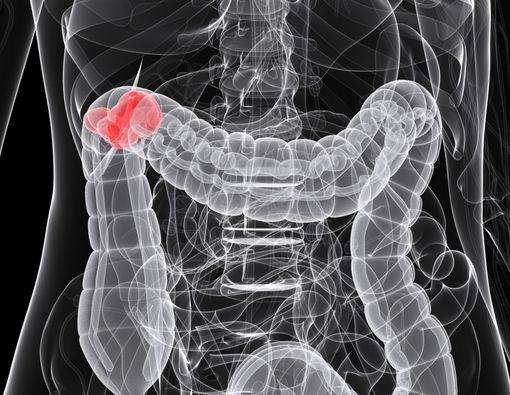 5 Gejala Kanker Usus yang Renggut Nyawa Eks KSAD George Toisutta