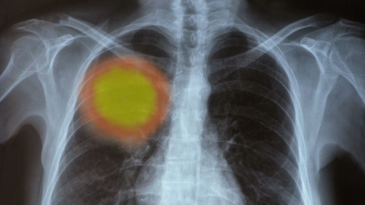 Komplikasi Kanker Paru yang Perlu Diketahui