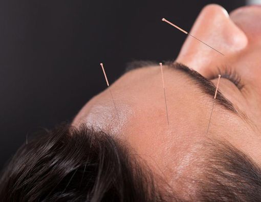 Bisakah Akupunktur Mengobati Nyeri Kepala?