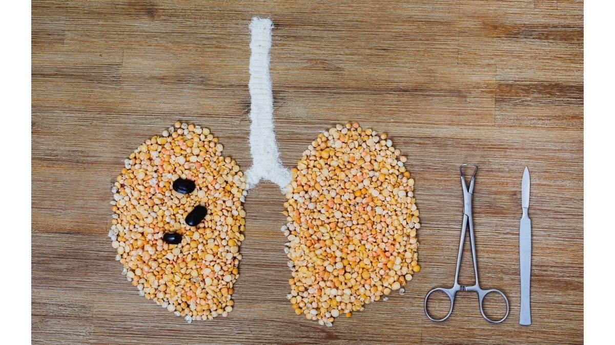 Mengenal Operasi Bulektomi untuk Mengobati Pasien PPOK