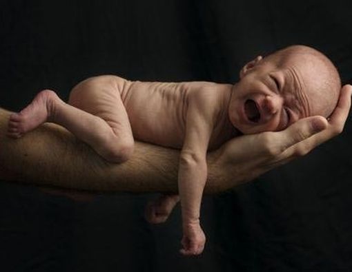 Penting! Jenis-Jenis Malnutrisi pada Si Kecil