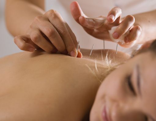 Benarkah Terapi Akupunktur Bisa Bikin Cepat Hamil?