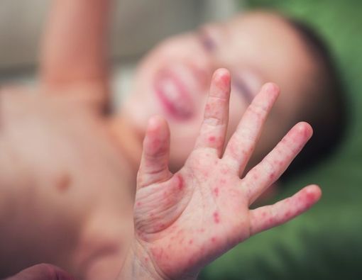 Anak Sudah Vaksin, tapi Kenapa Masih Kena Campak?