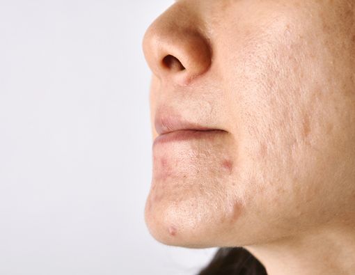 Penyebab Munculnya Breakout Setelah Eksfoliasi Kulit Wajah