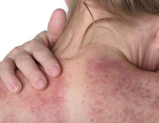 Bolehkah Kerokan Usai Operasi Caesar?