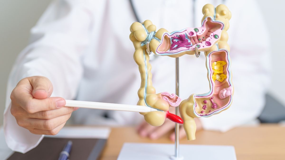 Mengenal Kanker Kolorektal dan Apakah Bisa Sembuh?