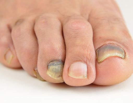 Suka Olahraga Lari? Waspada, Kuku Kaki Bisa Menghitam