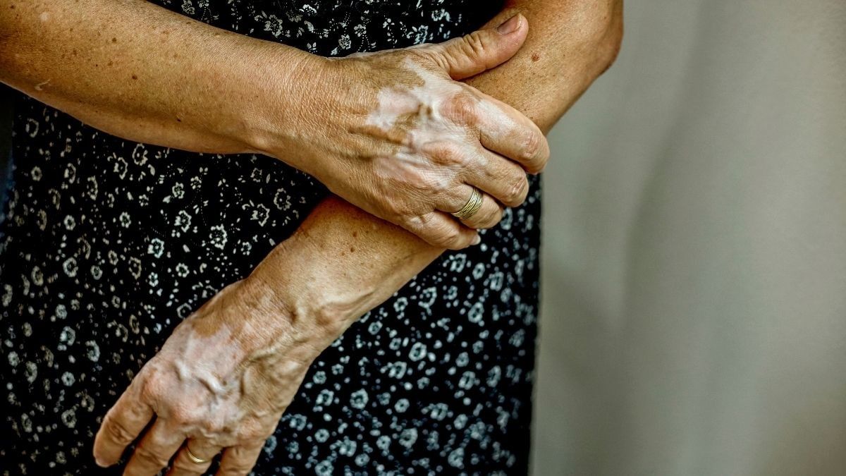 Vitiligo Bisa Sebabkan Depresi, Ini Cara Mengatasinya