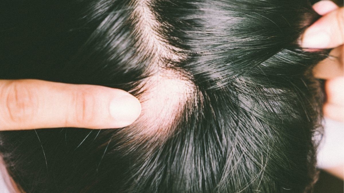 Penyebab Rambut Rontok Pada Penderita Diabetes