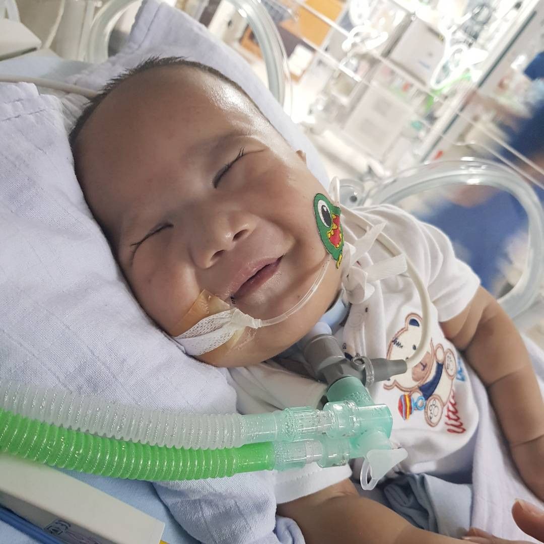 Penyebab Trisomi 13, Penyakit yang Diderita Adam Fabumi